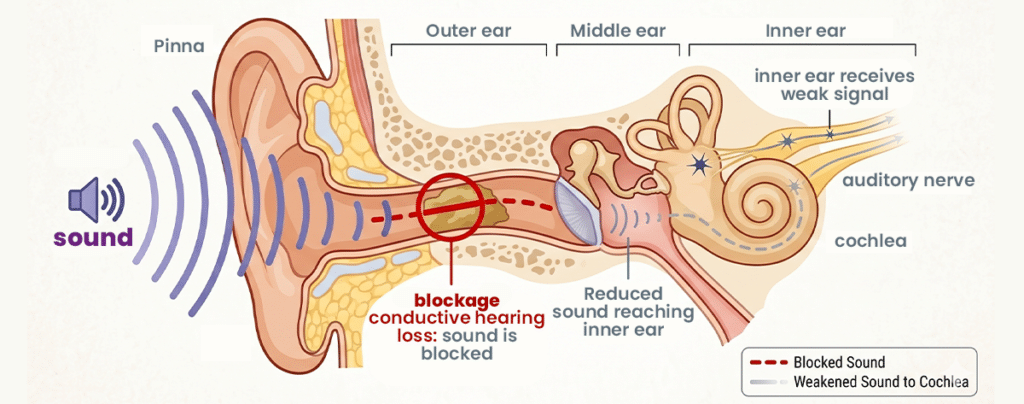 What Is Conductive Hearing Loss?